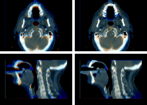 Figure 6.  Red/blue visualization of the difference between the rigid registration (left) and the deformable registration (right) of CBCT image 6 to the planning CT image. A saggital slice and an axial slice are shown for each registration.