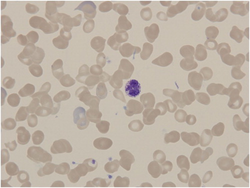 Figure 1. Peripheral blood smear in PMF patient showing circulating basophile among characteristically deformed red blood cells (dacryocytes).