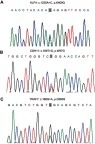 Figure 6 Sanger sequencing validation of point mutations in the secretory subtype meningioma. (A) Sanger sequencing confirmed a c.1225A>C mutation was observed in the KLF4 gene, resulting in p.K409Q. (B) Sanger sequencing confirmed a c.169T>G mutation was observed in the CDH11 gene, resulting in p.W57G. (C) Sanger sequencing confirmed a c.1678G>A mutation was observed in the TRAF7 gene, resulting in p.G560S.