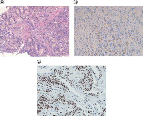 Figure 4. Histological examination of gastric metastasis.(A) Hematoxylin and eosin staining showing tumoral proliferation with rare glandular cavities. (B) Immunohistochemistry showing positive staining for CK7+. (C) Immunohistochemistry showing positive staining for TTF-1 (400×).