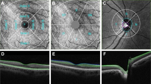 Figure 1 Measurement areas for macula Early Treatment Diabetic Retinopathy Study grid (A), macula 6 circle (B), and circumpapillary RNFL circle (C) overlaid with example projected images. Single-frame OCT B-scan images overlaid with boundaries (green and blue lines) demonstrated the retinal layers in various retinal thickness measurements, including full retinal thickness (D); ganglion cell + inner plexiform layers (distance between the 2 green boundaries), ganglion cell complex (distance between the blue and green boundaries, vitreal to inner nuclear layer) (E); and retinal neural fiber layer (F). All the images were set with right eye orientation.