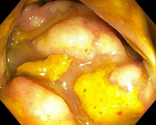 Figure 3 Additional Colonoscopy images from case no. 2.