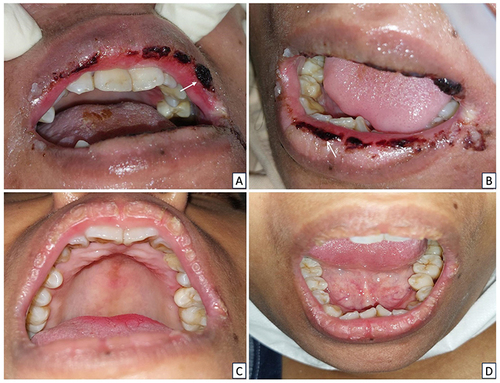 Figure 5 The extraoral lesions in patient Case 5 (A and B) On the first visit, there was a hemorrhagic crust on the upper and lower lips (C and D) The lesions resolved 15 days later.
