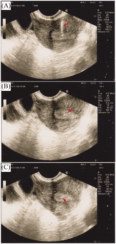 Figure 2. Transvaginal ultrasound (TVUS) during transmyometrial embryo transfer. A) catheter placement, (B) during embryo transfer, and (C) post embryo transfer.