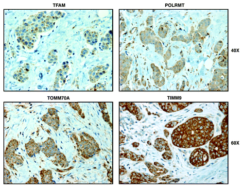 Figure 6. Markers of mitochondrial biogenesis (TFAM, POLRMT, TOMM70A, and TIMM9) are all predominantly confined to epithelial cancer cells in human breast cancer tumor tissues, but are largely absent from adjacent stromal cells. Paraffin-embedded sections of human breast cancer tumor tissue were immunostained with antibodies directed against TFAM, POLRMT, TOMM70A and TIMM9. Slides were then counter-stained with hematoxylin. Note that TFAM, POLRMT, TOMM70A and TIMM9 are all largely absent from the stromal compartment and confined to the epithelial compartment (brown color). Original magnifications, 40x and 60x, are as indicated.