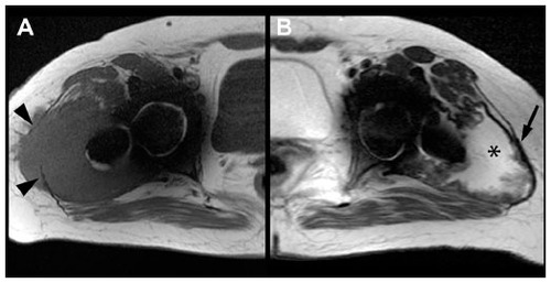 Figure 7 Axial T1 weighted (A) and T2 weighted (B) magnetic resonance images through bilateral metal-on-metal total hip replacements, demonstrating the typical features of adverse reaction to metal debris. There are large periprosthetic soft tissue collections that are isointense to muscle on T1W and fluid signal containing debris on T2W (asterisk). The collection is contained by a hypointense pseudocapsule comprising avascular fibrin and microscopic metallic particles, resulting in the very low signal only demonstrable on long TE sequences (arrow). On the right, the collection has breached the fascia lata (arrowheads) and extends into the subcutaneous fat, where it is palpable.