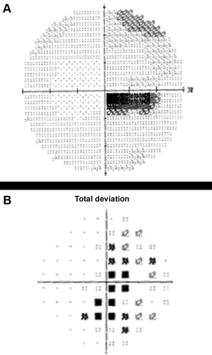Figure 1 Automated 30-2 protocol Humphrey visual field study of the right eye showing a dense cecocentral scotoma on the grayscale (A) and total deviation map (B) in a patient with acute LHON-related vision loss.