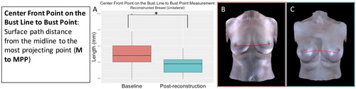 Figure 4. The centre front point on the bust line to bust point measurement (midline to most projecting point) significantly decreased in the reconstructed breast after unilateral implant-based reconstruction (p = 0.03). (A) Boxplot of the centre front point on the bust line to bust point measurement at baseline and post-reconstruction (median and interquartile range). (B) The centre front point on the bust line to bust point measurement on an exemplar patient at baseline. (C) The centre front point on the bust line to bust point measurement on the same patient post-reconstruction.