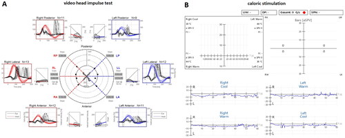 Figure 2. A: Video head impulse test: loss of function of all six semicircular canals on both sides. B: Air caloric stimulation (warm and cold): missing response on both sides.