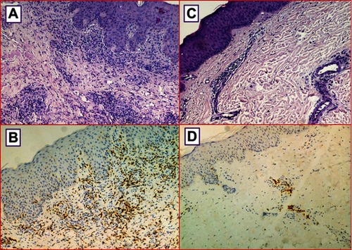 Figure 2 The cutis is infiltrated by perivascular small lymphocytes (A and C) (H&E; original magnification, 100×); the lymphocytes show CD8 positivity (B and D) (immunoperoxidase staining; original magnification, 100×).