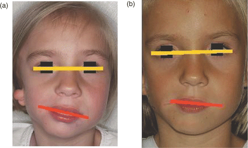 Figure 10. Patient's face before (a) and after (b) distraction. [Color version available online.]