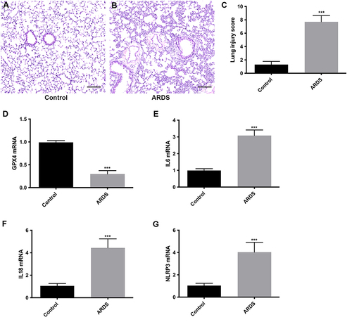 Figure 10 The expression levels of 4 PRGs (GPX4, IL6, IL18 and NLRP3) in alveolar macrophages of mice. (A) HE staining of normal mouse lung tissue (magnification ×200); (B) HE staining of ARDS mouse lung tissue; (C) Lung tissue injury score. Expression levels of GPX4 (D), IL6 (E), IL18 (F) and NLRP3 (G) mRNA were quantified using qRT-PCR. ***P < 0.001.