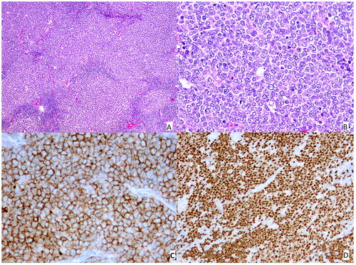 Figure 1. panels A–B: Hematoxylin and eosin stain original magnification ×500 [a], ×1000 [B]; panel C: Immunohistochemistry CD10; panel D: Immunohistochemistry nuclear MUM1.
