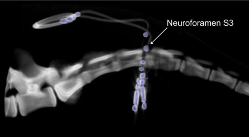 Figure 4 Final CT reconstruction of bilaterally implanted tined leads (in blue) at the neuroforamen S3.