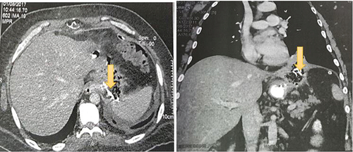 Figure 4. CT scan axial view showing a slight decrease in the size of the subphrenic collection with a persistent fistula and a spongiform formation with opaque serpiginous structures (yellow arrow) typical of a textiloma.