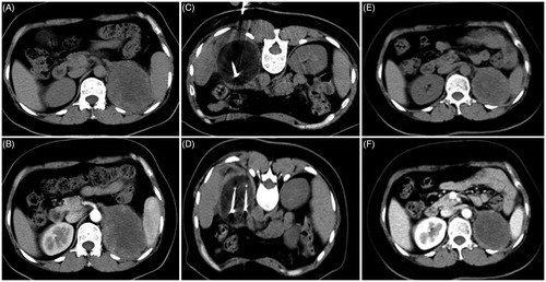 Figure 7. A 48-year-old woman with a tumor on the left kidney accompanied by bone metastasis who underwent cryoablation combined with sorafenib. (A, B) Preoperative CT scans show that the tumor was located in the lower pole of the left kidney, with the largest tumor diameter of 7 cm. (C, D) CT scans show complete ablation of the tumor during cryoablation. (E, F) CT scan at 1 month after cryoablation shows that the tumor is completely necrotic.
