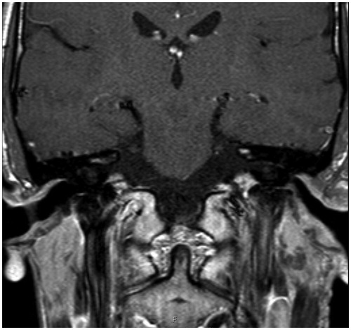 Figure 5. A T1-weighted magnetic resonance image obtained 2.5 years postoperatively shows that both external ear canals are open and the surrounding soft tissues are normal.