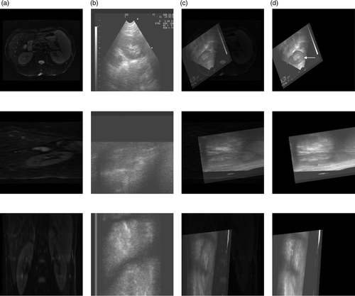 Figure 9. Registration between MR and ultrasound images of the kidney. (a) Reference image in axial (top), sagittal (middle) and coronal (bottom) planes. (b) Floating image in axial, sagittal and coronal planes. (c) Fused image after affine registration in axial, sagittal and coronal planes. (d) Deformed floating image after local non-rigid registration in axial, sagittal and coronal planes.