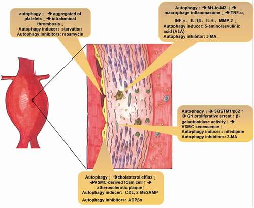 Figure 1. Potential molecular mechanism by which autophagy plays a protective role in AAA pathogenesis. Thrombosis: Enhanced autophagy could decrease intraluminal thrombosis by reducing the aggregation of platelets. Macrophages: Autophagy deficiency leads to hyperactivation of the macrophage inflammasome and enhances plaque progression, thereby releasing inflammatory cytokines, such as TNF-α, IL-1β, and MMP-2, which ultimately exacerbate AAA formation. VSMC senescence: Deficient autophagy could accumulate SQSTM1/p62 and accelerate the development of stress-induced senescence, as indicated by cellular and nuclear hypertrophy, CDKN2A-RB-mediated G1 phase arrest and senescence-associated β-galactosidase activity. Atherosclerosis: Deficient autophagy exacerbates atherosclerotic plaques by reducing cholesterol efflux and exacerbating VSMC-derived foam cell generation