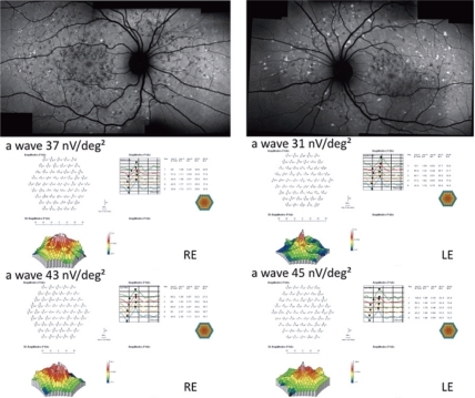 Figure 3 Fundus autofluorescent frames (upper left and right panels) and mfERG for case seven. The peak of the a wave increased from 37 nV/deg2 to 43 nV/deg2 in the RE, and from 31 nV/deg2 to 45 nV/deg2 in the LE. The peak of the b wave improved from 70 nV/deg2 (middle left panel) to 89 nV/deg2 (bottom left panel) in the RE, and from 101 nV/deg2 (middle right panel) to 108 nV/deg2 (bottom right panel) in the LE.