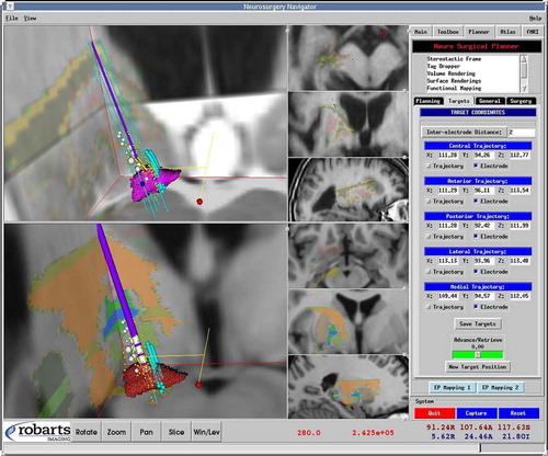 Figure 1. The primary graphical user interface of the system displays the 3D image volume and 2D slices of a patient (top) and those of the standard brain template (bottom). The digitized atlas is registered and fused with each image. A T2-weighted image fused with the patient image is also shown. The control panel shows the tip locations for the five probes. [Color version available online.]