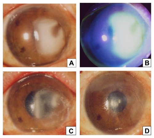 Figure 1 Slit-lamp photographs. (A) Oval infiltrate with irregular margins in the nasal half of the cornea at initial presentation. (B) Fluorescein staining at initial presentation. The lesion was not stained with fluorescein. (C) One week after admission, the infiltrate improved, but in the central part was still deep. (D) A stromal scar remained 3 months after the patient was discharged.