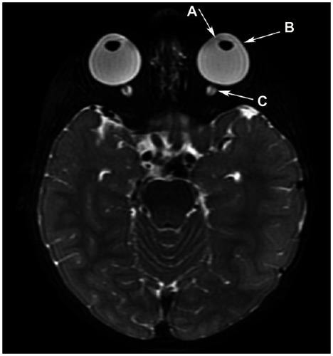 Figure 4 Axial T2WI depicting iris thinning in association with buphthalmos, enlarged anterior chambers, and lens rounding. (A) Iris thinning in association with buphthalmos, enlarged anterior chambers, and lens rounding. Megalocornea is present with (B) lateralization and flattening of the limbus. (C) The optic nerve sheaths are prominent.