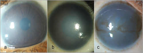 Figure 1. Grading of corneal haze. (a) Mild disease with minimal corneal cloudiness not obscuring the iris details. (b) Moderate corneal haze obscures the iris details, but the pupillary silhouette could be seen. (c) Severe disease wherein the iris, and pupillary details both are obscured (Ramappa et al.Citation4).