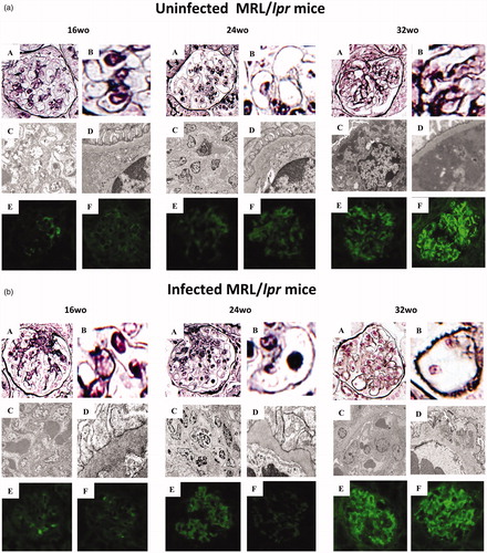 Figure 2. Altered histopathology of glomerulonephritis in MRL/lpr mice uninfected (1a) and infected (1b) with S. mansoni. (A) and (B). Light microscopic images of the kidney (PAM). (A) A representative glomerulus; original magnification, × 400. (B) High-zoom feature of basement membrane, × 800. (C) and (D), Electron micrograph of the glomerulus. (C) A feature of mesangial region, × 4000 (D), a feature around glomerular basement membrane (GBM), × 4000. E and F, Immunostaining of the glomerulus. (E) With anti-mouse IgG1 antibody, × 400 (F) with anti-mouse IgG2a antibody, × 400. 16 wo: (A) Mesangial cell proliferation was mild. (B) GBM thickening was not seen. Foot processes were normal. (C) Mesangial cells were slightly increased. (D) No abnormalities in either podocytes or GBM. Scant staining of IgG1 (E) and IgG2a (F) was recognized.24 wo: (A) Mesangial cell proliferation was moderate. (B) GBM thickening was not seen. Foot processes were normal. (C) Mesangial cells were slightly increased. (D) No abnormalities were seen in podocytes or GBM. IgG1 (E) and IgG2a (F) were equally lightly stained. 32 wo: (A) Mesangial cell proliferation associated with crescent formation was clearly recognized. (B) GBM thickening was recognized. (C) Subendothelial dense deposits were clearly recognized with mesangial cell proliferation. (D) Remarkable subendothelial deposition was observed. IgG1 (E) and IgG2a (F) were clearly stained. Notably, IgG2a (F) was stronger than IgG1 (E).(b) 16 wo: (A)–(F) Findings were similar in infected and uninfected mice. 24 wo: (A)–(D) Findings were similar in infected and uninfected mice. IgG1 (E) was clearly stained around GBM, but IgG2a (F) was not. 32 wo: (A) GBM thickening was clearly recognized. Mesangial cells were recognized, but milder than in uninfected mice. (B) GBM thickening with spike formation was apparent. (C) Subendothelial dense deposits were not recognized. (D) Subepithelial dense deposits with GBM thickening and foot process effacement were clearly recognized. IgG1 (E) was more apparent than at 24 wo. IgG2a (F) was also stained.