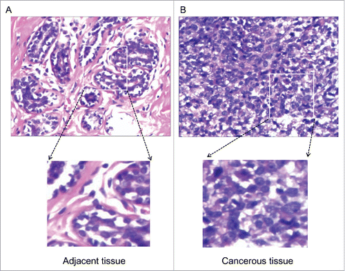 Figure 1. HE staining of patient's tissue. A, Adjacent tissue. B, Photomicrograph showing eccentric nuclei, prominent nucleoli and occasional giant cells.