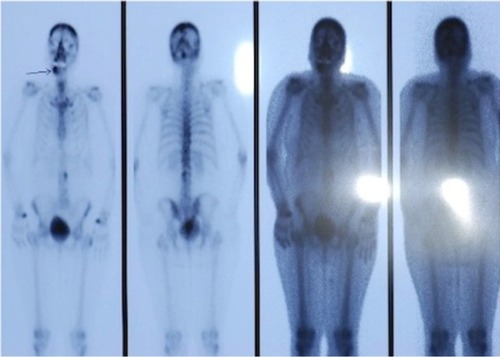 Figure 2 Bone scintigraphy taken 2 months after root canal treatment.