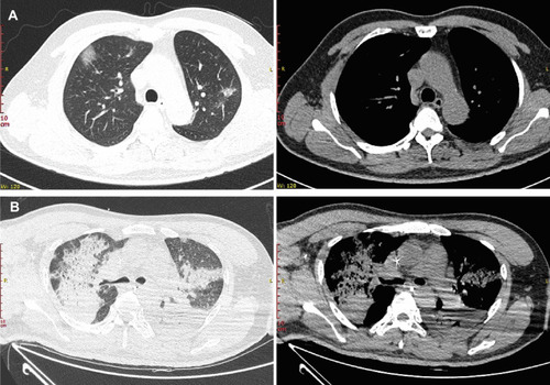 Figure 1 Representative chest CT images of patients with COVID-19 or adenoviral pneumonia. (A) Chest CT of COVID-19 showing multiple peripherally distributed ground-glass opacities in bilateral lung. (B) Chest CT of adenovirus pneumonia showing bilateral consolidation and left-sided pleural effusion.
