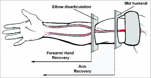 Figure 6. Possible levels of transection during upper extremity recovery. For forearm/hand transplantation, disarticulation at the level of the elbow is sufficient. For more proximal requirements, transection is typically at the level of the mid-humerus.