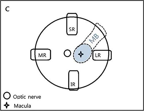Figure 2 Location of the exoplant. A schematic drawing shows the location of the exoplant in a left eye. The exoplant is inserted superotemporally to reach the macular area.Abbreviations: IR, inferior rectus muscle; LR, lateral rectus muscle; MB, macular buckle; MR, medial rectus muscle; SR, superior rectus muscle.
