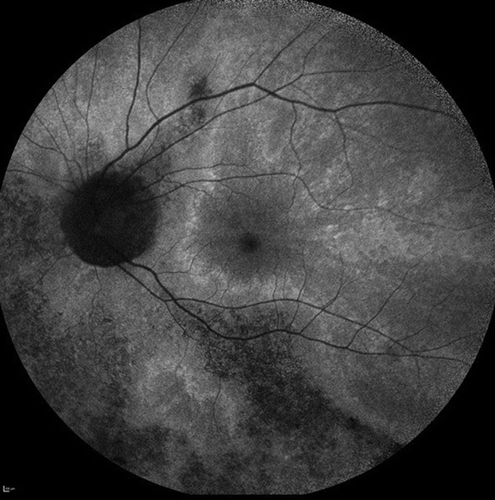 Figure 2. X-linked female carrier AF image showing the tapetal-like reflex centred on the fovea and patchy peripheral pigmentation. The mosaic picture is due to random X-inactivation generating clones of normal or degenerate photoreceptors. Since as with males, the degeneration takes time to manifest, a clearer X-linked carrier phenotype will generally be seen on the mothers of affected men rather than their daughters.