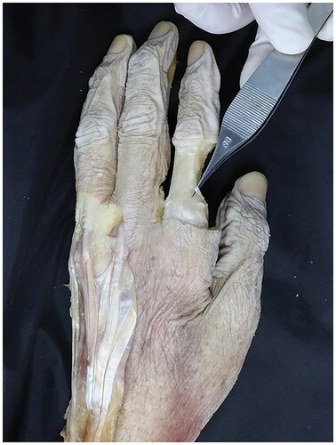 Figure 3. This reveals the insertion of the accessory first lumbrical muscle of the left index finger.
