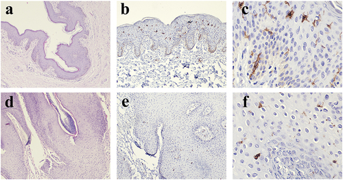Figure 1 The histopathological presentation of normal skin ((a) HE staining 40x) and condyloma acuminatum skin lesions ((d) HE staining 100x). Expression of CD207 in normal foreskin tissue ((b) immunohistochemistry staining 100x, (c) immunohistochemistry staining 400x) and CA skin lesions ((e) immunohistochemistry staining 100x, (f) immunohistochemistry staining 400x). It shows that the number of CD207-positive cells is higher in normal foreskin tissue, distributed throughout the entire epidermal layer, and has obvious dendritic-like structures. In CA skin lesions, the number of CD207-positive cells is lower, distributed in the lower part of the epidermis, and with less obvious dendritic-like structures.