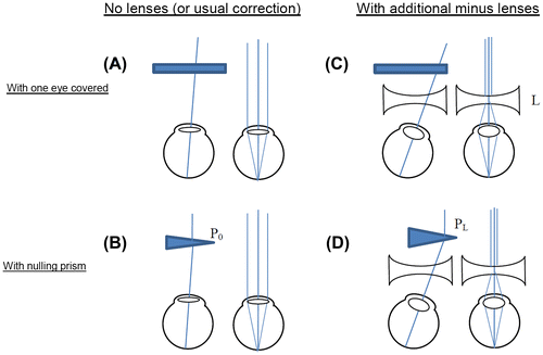 Figure 1. Gradient method for measuring AC/A ratio. The eyes view an object at 6 m (effectively infinity), so accommodation is relaxed. One eye is covered (A). It then takes up the convergence state which is neurally hard-wired for this accommodation state, i.e. the accommodative convergence. This is measured by finding the strength, P0, of the prism which is required in order to cancel out any movement when the eye is covered and then uncovered (B). This prism enables both eyes to fixate the object while keeping their natural accommodative convergence. This process is then repeated with diverging lenses (minus lenses) in front of the eyes (C and D); L is the strength of the diverging lens, in dioptres.