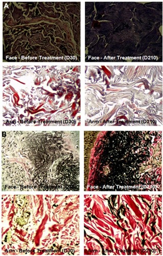 Figure 2 Histological exam showing collagen and elastic fibers of face and left arm before and after treatment.