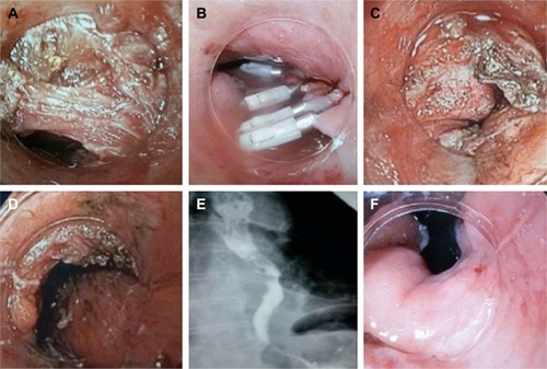 Figure 2 Successful bilateral POEM in a 92-year-old female with sigmoid-type-III achalasia and frequent episodes of pneumonic aspiration: (A) anterior myotomy. Circular muscle layer is relatively thick. (B) Mucosal entry closing by clips after anterior POEM. (C, D) Redo-posterior POEM. Myotomy site and mucosa are recognized within the submucosal tunnel. (E) Esophagogram 1 day after posterior POEM showed rapid passage of the contrast medium (gastrografin). (F) Easy passage of the endoscope without resistance through GEJ and open GEJ in retroversion after posterior POEM.