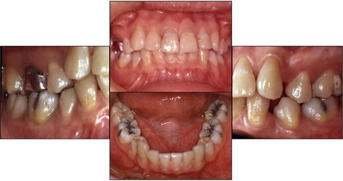 Figure 1. Baseline intraoral photos.