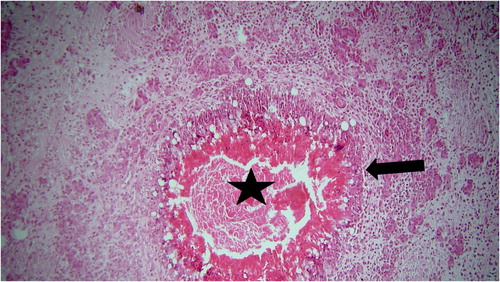 Figure 2. Caseous necrosis in the centre (asterisk) surrounded by granulomatous inflammation (arrow) (haematoxylin and eosin staining, ×100).