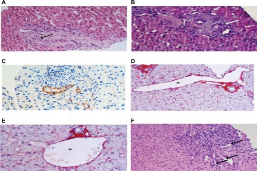Figure 1 Histologic features of the portal tracts in INCPH.