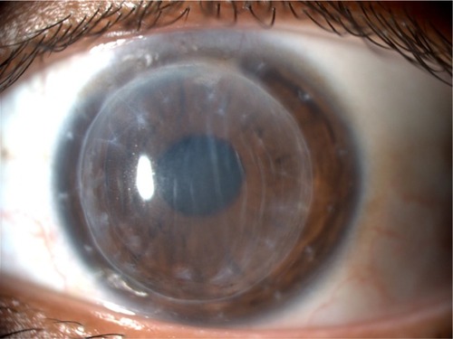 Figure 3 Clinical picture of corneal endothelial graft rejection 1 month after the injection.