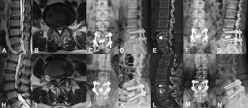 Figure 6 PE-TLIF group (A–G): A 63-year-old female patient who suffered low back pain with right leg pain and numbness for 3 years, intermittent claudication 50m, and was treated by PE-TLIF. (A and B) Preoperative MRI showed a lumbar spinal stenosis on L4/5. (C and D) X-ray images showed a good implantation position at 7 days after operation. (E) CT scan image showed a standard lumbar fusion at 6 months after operation. (F and G) X-ray images showed a good implantation position at final follow-up. PLIF group (H–N): A 52-year-old female patient who suffered low back pain with right leg pain and numbness for 2 years, intermittent claudication 100m, and was treated by PLIF. (H and I) Preoperative MRI showed a lumbar spinal stenosis on L4/5. (J and K) X-ray images showed a good implantation position at 7 days after operation. (L) CT scan image showed a standard lumbar fusion at 6 months after operation. (M and N) X-ray images showed a good implantation position at final follow-up.