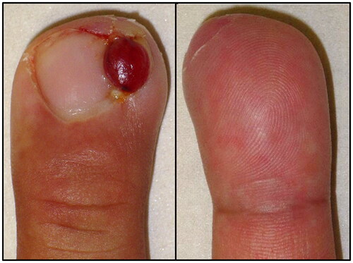 Figure 1. Appearance of the right middle finger at the time of initial examination. A smooth erythematous nodule 7 mm in size was observed on the ulnar lateral nail fold. The nail is shifted to the radial side. The subcutaneous area under the nodule was indurated, swollen, and tender. (left) Dorsal side of the affected finger. (right) Palmar side of the affected finger.