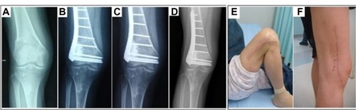 Figure 6 Images of a 47-year-old woman treated by a giant cell tumor resection and fixed with an internal steel plate after the porous n-HA/PA66 composite grafted in the right distal femur.Notes: Periodic radiological assessments showed that the new bones developed and the porous n-HA/PA66 composite incorporated with the host bone gradually. The internal steel plate was still rigidly fixed and no joint surface subsidence occurred. (A) Preoperative; (B) a half-year after resection; (C) 1 year; and (D) 5 years later. The grafting-to-non-lesion count ratio was 0.78 and the MSTS score was 29 after 5 years follow-up (E and F).Abbreviations: n-HA/PA66, nano-hydroxyapatite/polyamide 66; MSTS, Musculoskeletal Tumor Society score.