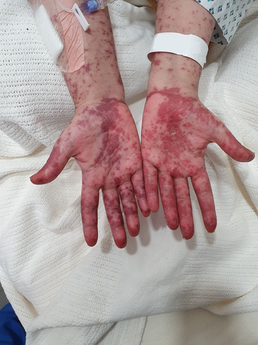 Figure 1 Picture taken during flare of erythema multiform: showing maculopapular, blanchable, dusky and red in color that was non-itchy rash and involved both hands, forearms, body and lower limbs.
