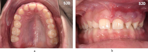 Figure 4 Palatal and gingival angiomatosis. Note the abrupt demarcation at the midline (a and b).