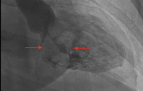 Figure 3. Left ventriculogram demonstrated filling defect of the myxoma in the left atrium